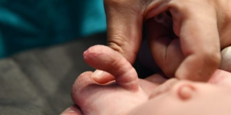 Hypospadias-Treatment-in-Children
